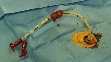 Image Of A Placed Percutaneous Endoscopic Gastrostomy Tube With An