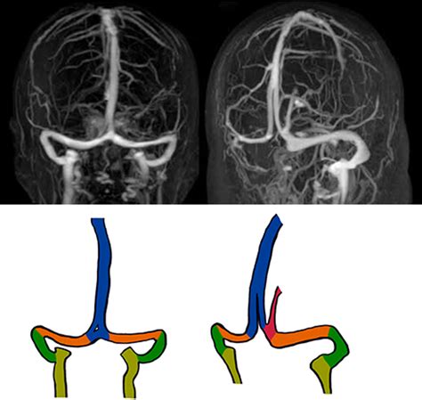 Magnetic Resonance Venography And Illustration Of The Sss Bifurcation