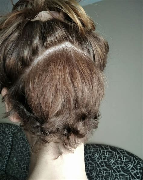 can radiotherapy cause hair loss 10