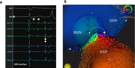 A Surface Ecg Leads V And V And Intracardiac Electrograms Recorded