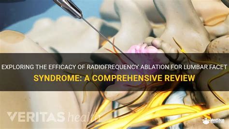 Exploring The Efficacy Of Radiofrequency Ablation For Lumbar Facet