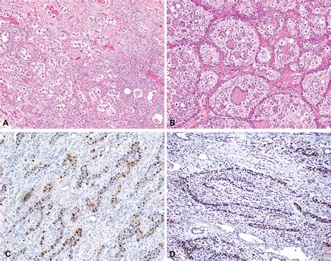 On The Histogenesis Of Mixed Germ Cell Sex Cord Stromal Tumour Of The