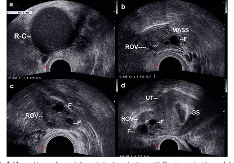 Ultrasound Guided Interventional Therapy For Recurrent Ovarian