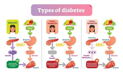 Diabetes Mellitus Definition Quick Facts Symptoms And Types Page 4