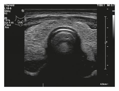 Thyroid Ultrasonography Of The Patient Demonstrating Thyroid