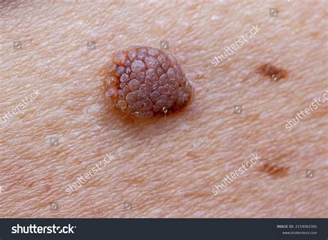Oncology Mole Big Wart On Skin Stock Photo 2154062391 Shutterstock