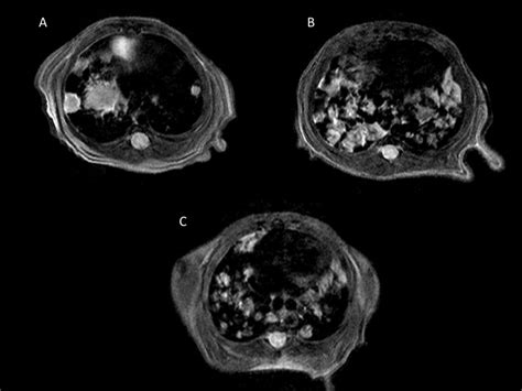 Lung tumor, MRI | Lurie Family Imaging Center