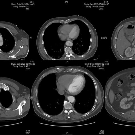Radiographic Image Of Fenestration Technique A Preoperative Cta