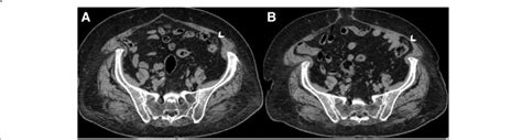 Evolution Of Acute Epiploic Appendagitis In A 72 Year Old Woman A