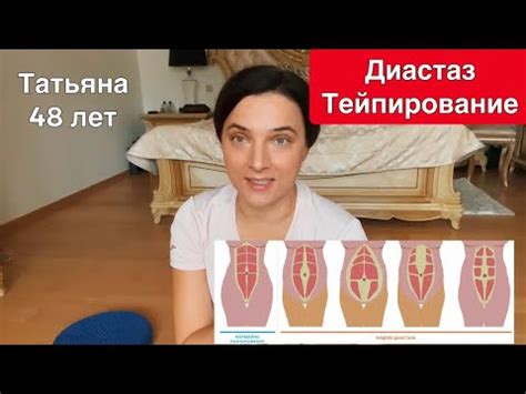 Диастаз. Тейпирование - YouTube