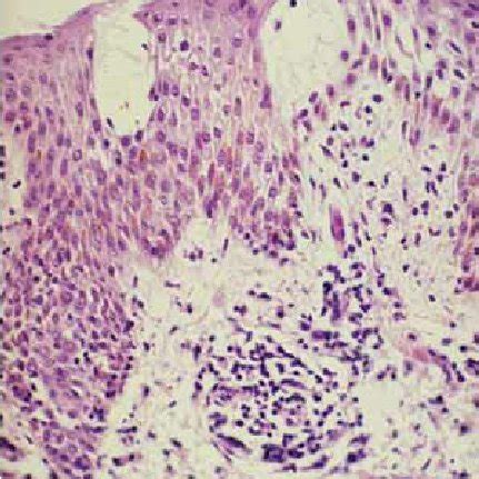 14. “Juvenile plantar dermatosis,” plantar aspect (same 10-year-old boy ...