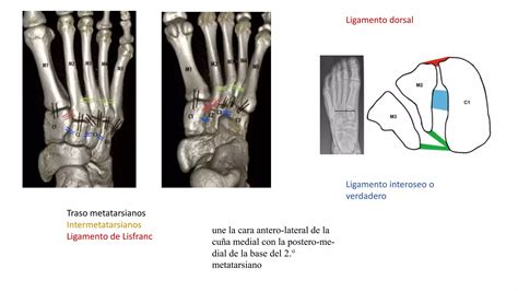 Fractura Luxaci N De Lisfranc Ppt