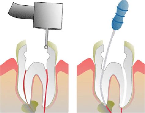 Tidbits of Molar Root Canal | Emergency Dentist San Jose CA