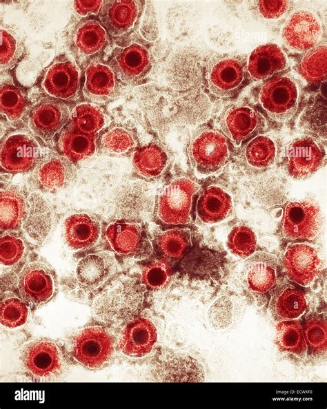 Transmission Electron Micrograph Of Herpes Simplex Virions Stock Photo