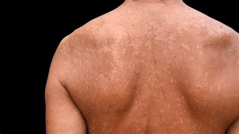 Tinea Versicolor Symptoms Causes And Treatment