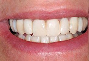 Dental Implants In Lutz Clearcorrect In Lutz Veneers In Lutz