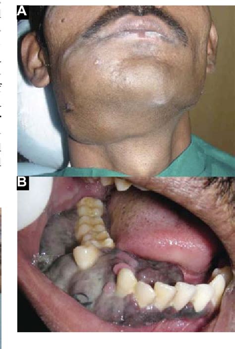 Figure 2 From Malignant Melanoma Of The Mandibular Gingiva Semantic