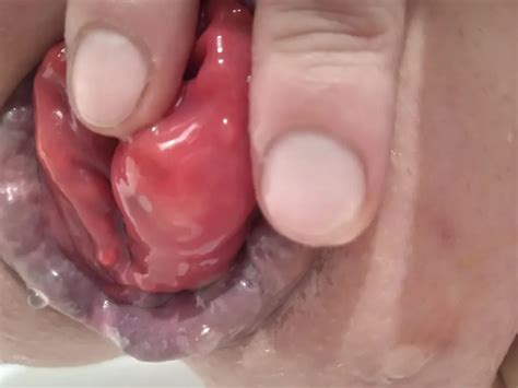 Prolapse 42 Nude Pics XHamster