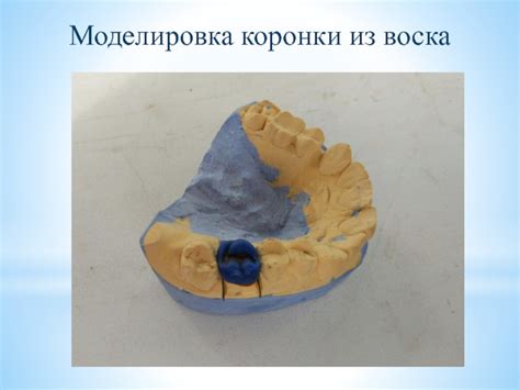 Технология изготовления цельнолитой коронки на моляр