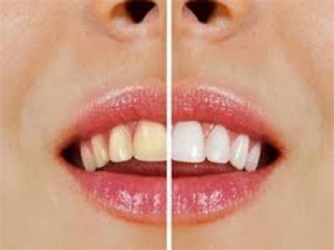 Aprenda Como Clarear Os Dentes De Forma Simples E Barata Sa De