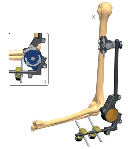 Elbow Fracture Or Dislocation Treatments Orthofix Abs