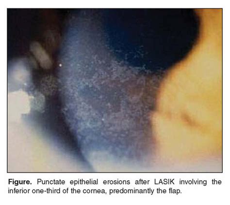 Punctate Epithelial Erosions