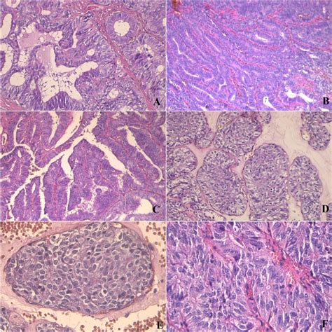 Cribriform Adenocarcinoma