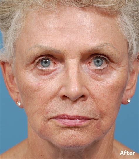 Fraxel® Laser Skin Resurfacing In Edina Mn For Minneapolis St Paul