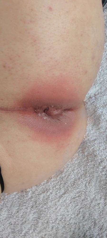 Appel Anal 59 Pics XHamster