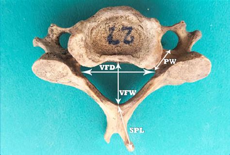 Typical Cervical Vertebra Superior View Download Scientific Diagram