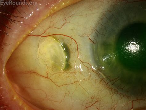 Senile Scleral Plaque