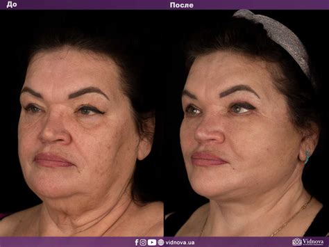 Подтяжка Лица Картинки – Telegraph