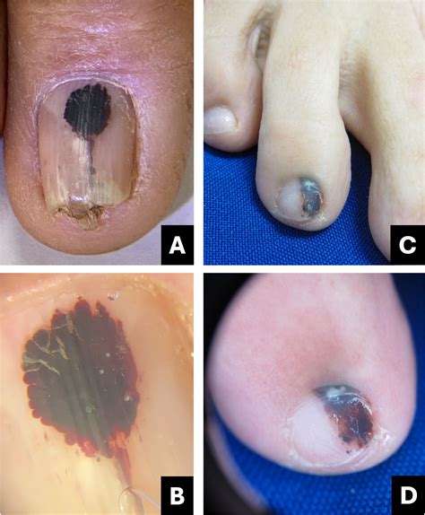 Early Subungual Melanoma