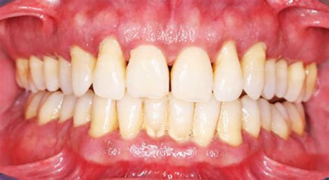 Лечение десен от 200 рублей в Казани | Лечение воспаления десен