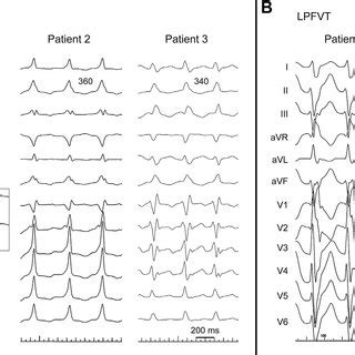 Patient Left Septal Mapping During Sinus Rhythm Reverse Type Lpfvt