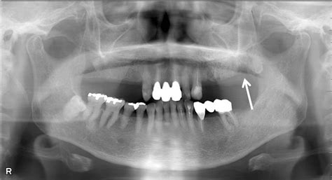 dental panoramic radiograph  extraction    focus