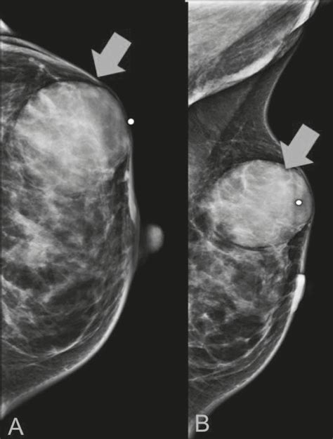 Scielo Brazil Sarcomas Of The Breast Findings On Mammography