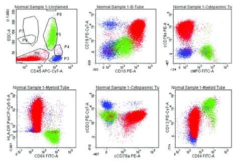 B ALL With Aberrant Expression Of CD13 Blasts Are Positive For CD19