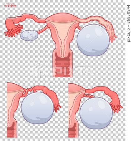 Illustration Of Ovarian Cyst Stock Illustration 86950944 PIXTA