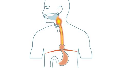 Reflux-symtomen som inte går att behandla med refluxmedicin