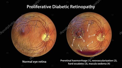 Retinopat A Diab Tica Proliferativa Ilustraci N D Que Muestra