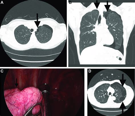 CT Chest Axial A And Coronal B Views Showing Bilateral Apical Blebs