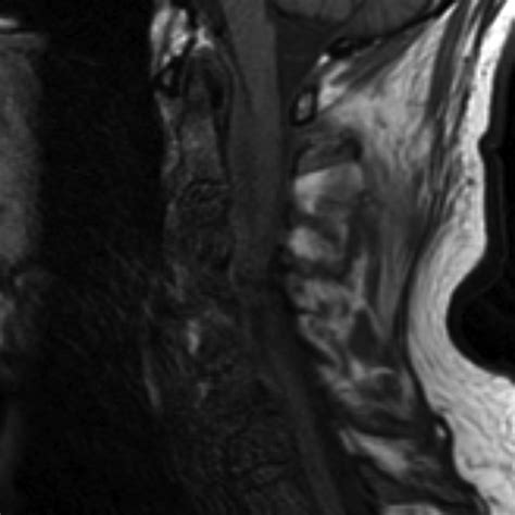 Epidural Abscess Of The Cervical Spine Image