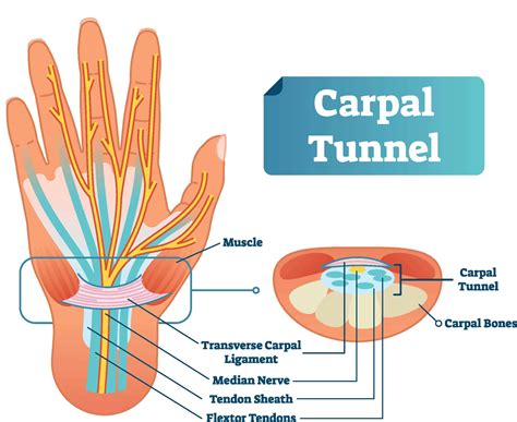 Carpal Tunnel Syndrome:Symptoms, Causes, PreventionDunbar Medical
