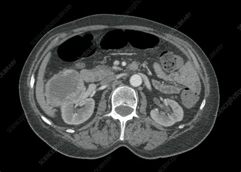 kidney cancer ct scan stock image  science photo library