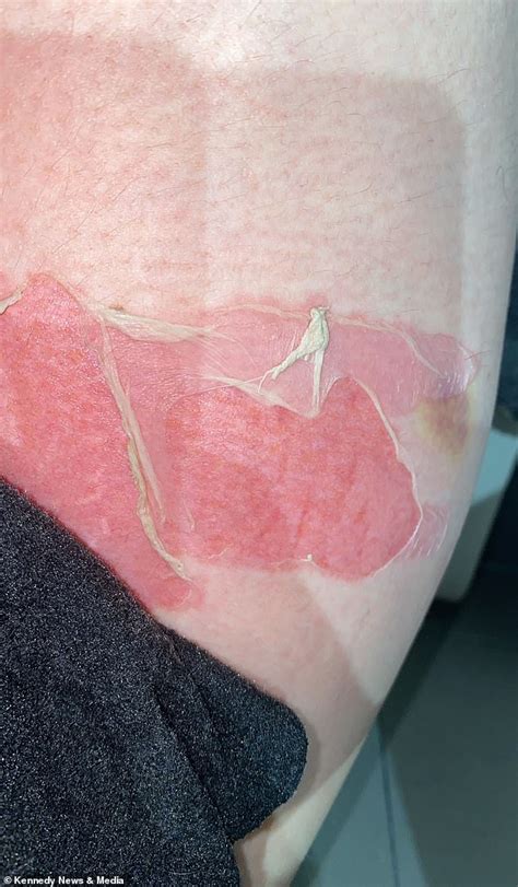 You Must Know Your Hot Water Bottle S Expiry Date As Woman S Old One Exploded Leaving Her