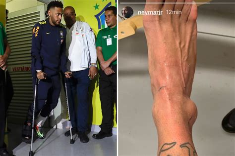 Neymar Reveals Gruesome Bulging Ankle As Brazil Ace Is Ruled Out Of