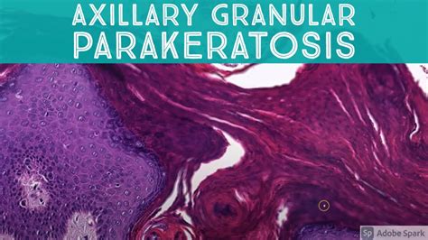 Axillary Granular Parakeratosis: 5-Minute Pathology Pearls - YouTube