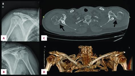 Preoperative Anteroposterior Right A And Left B Shoulder Download Scientific Diagram