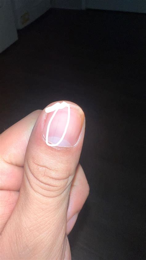 What can this be on my fingernail? : r/DiagnoseMe
